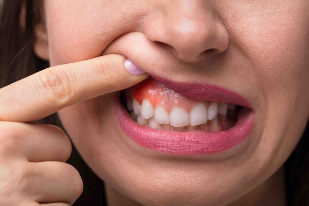 Come spazzolare i denti con parodontite