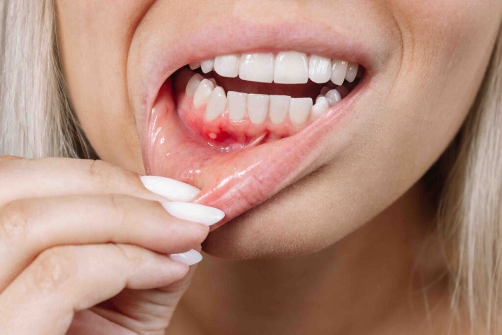 piorrea e perdita dei denti