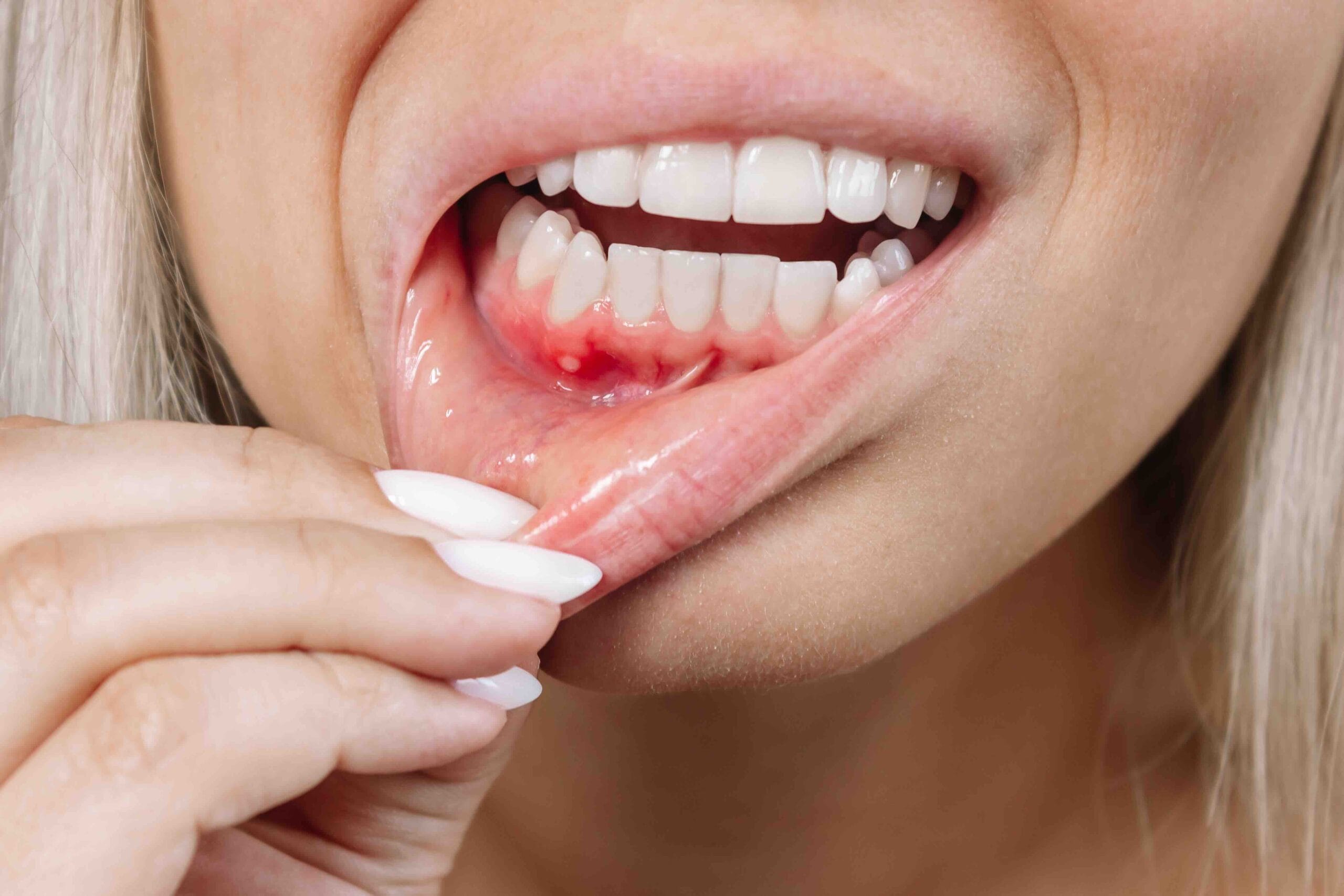 piorrea e perdita dei denti