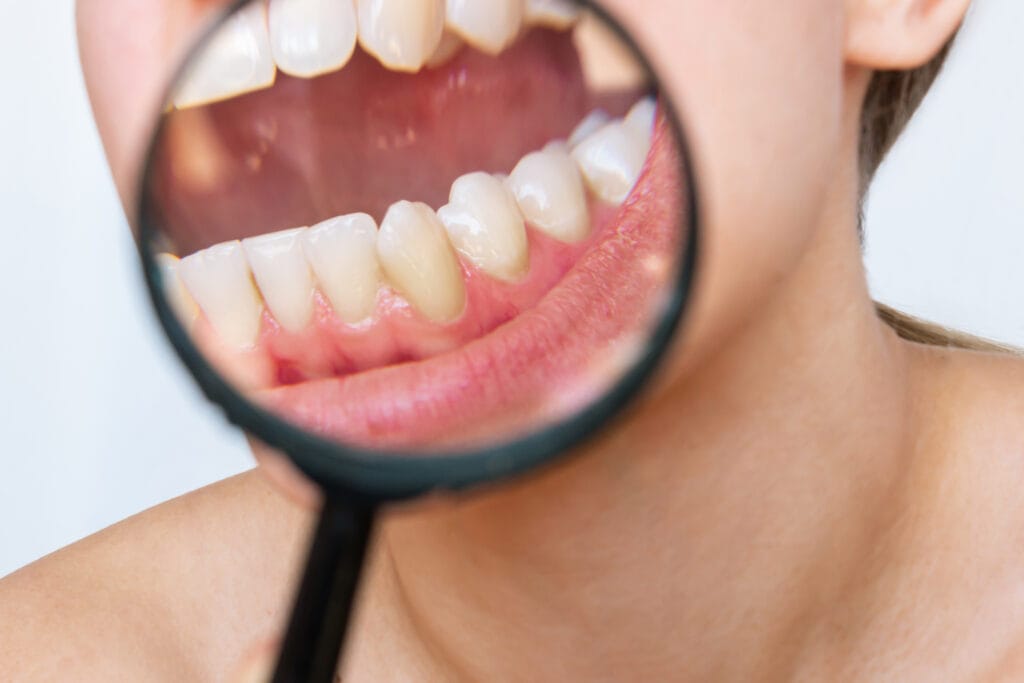 diagnosi della piorrea: esami, segnali e controlli per capire come riconoscerla in tempo.