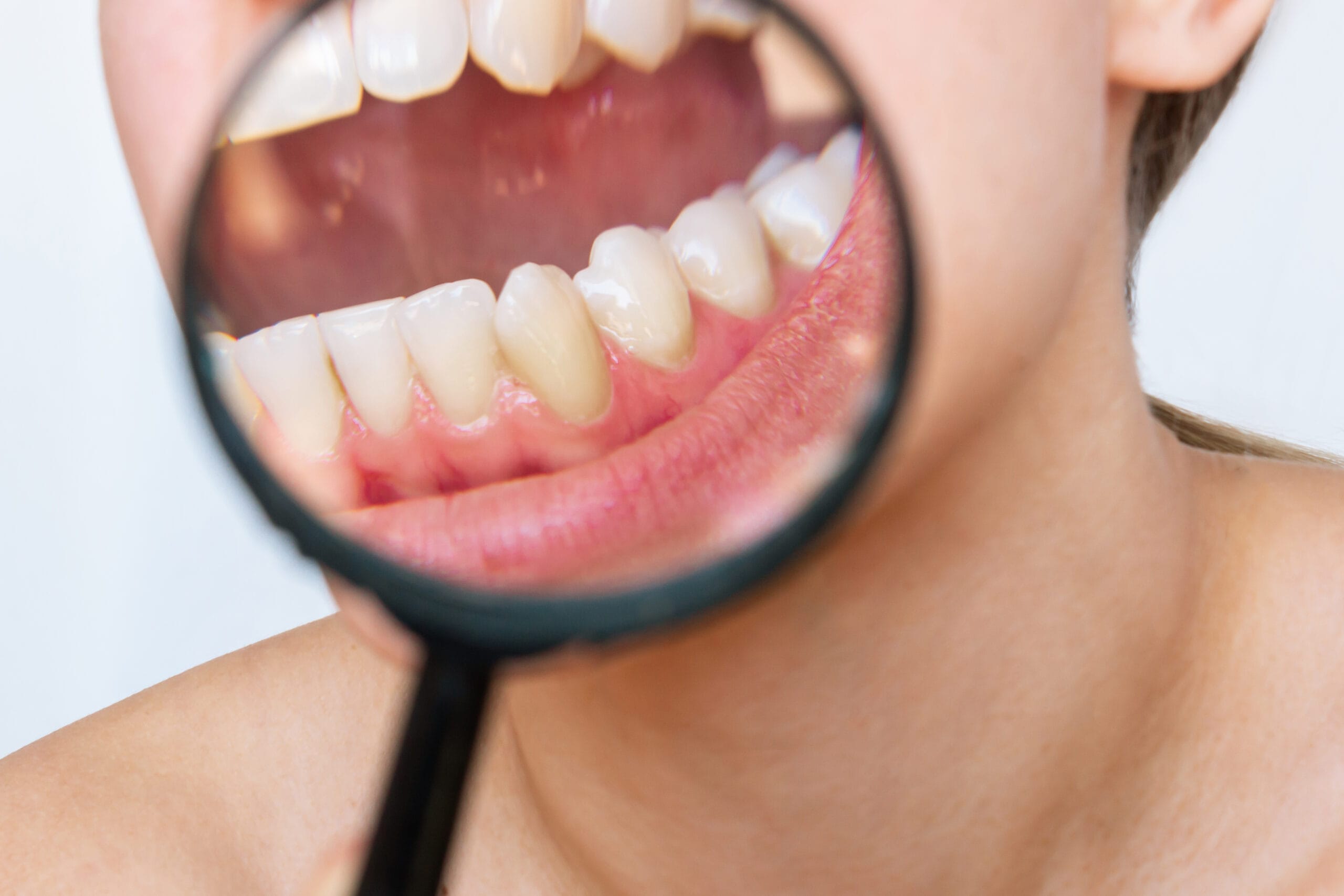 diagnosi della piorrea: esami, segnali e controlli per capire come riconoscerla in tempo.