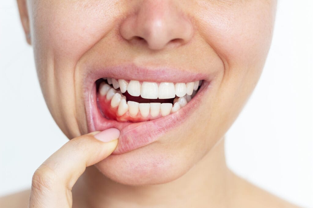 Gengive ritirate con recessione gengivale, denti più lunghi e sensibilità dentale al freddo