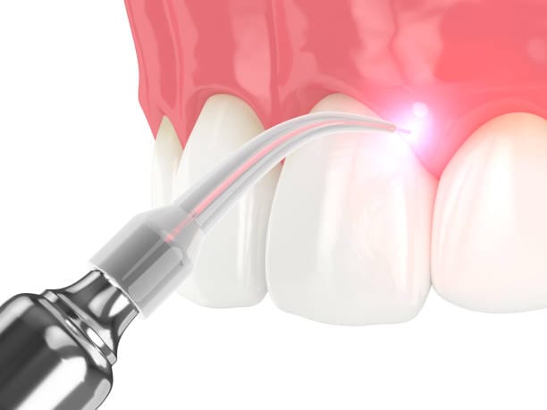 Cura della parodontite con il laser per ridurre batteri sottogengivali e infiammazione gengivale