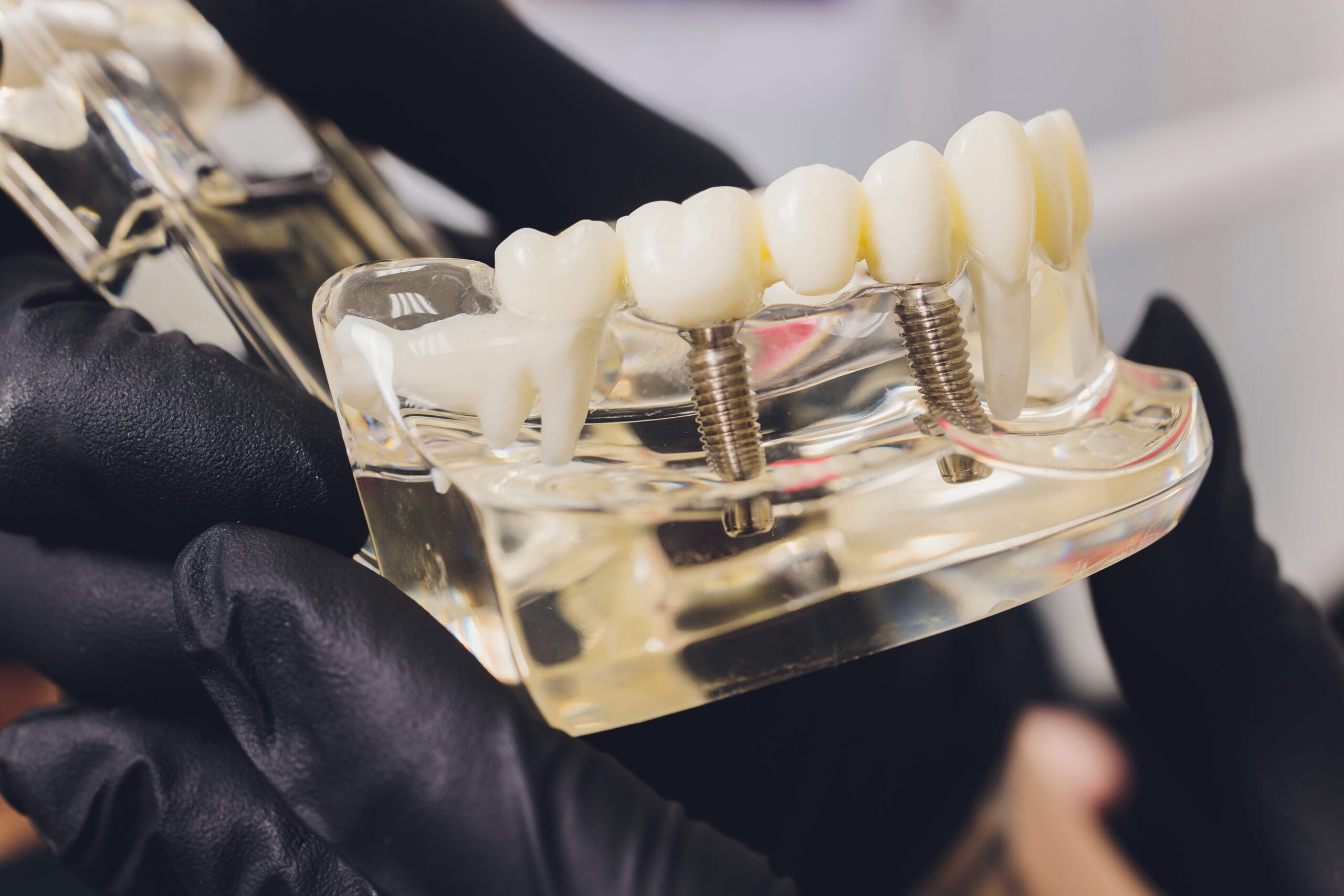 Salvare i denti naturali