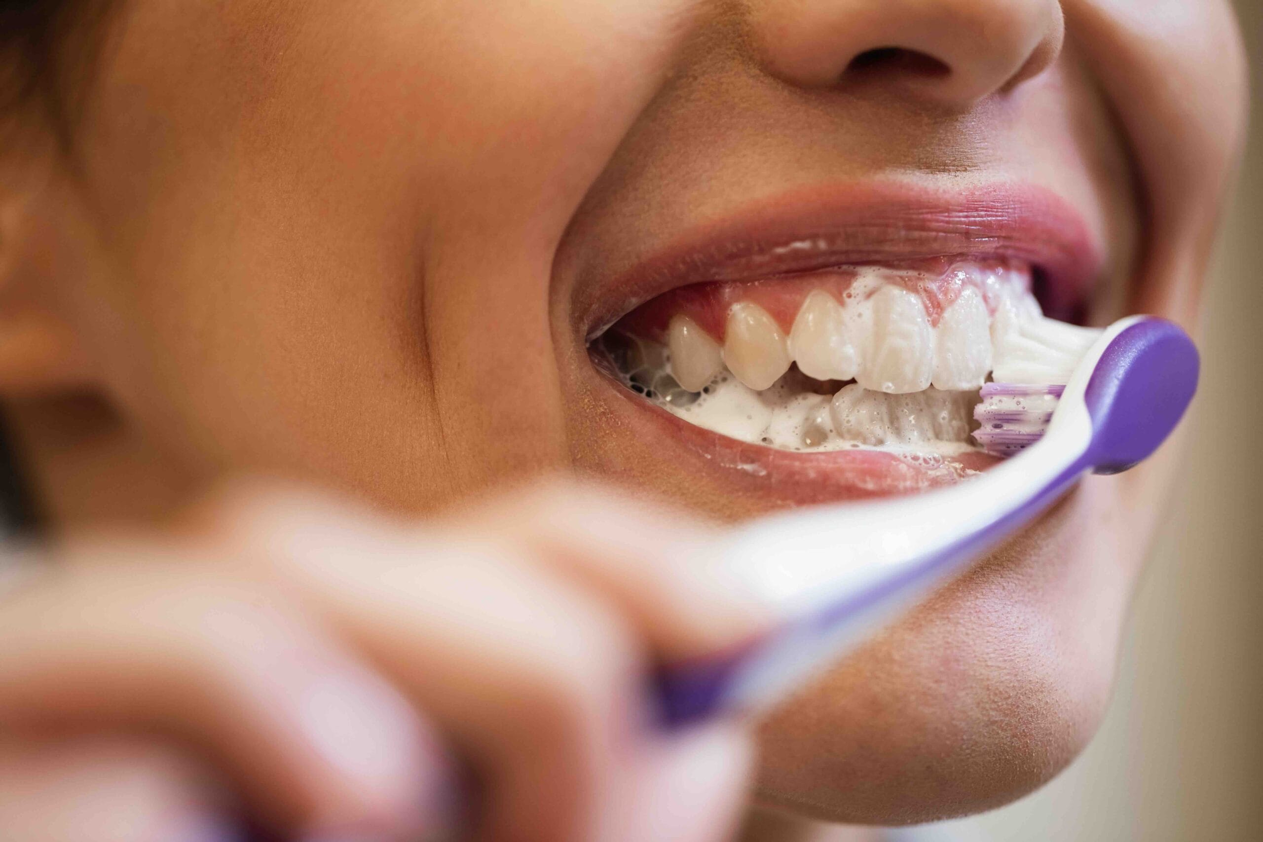 Come prevenire la gengivite